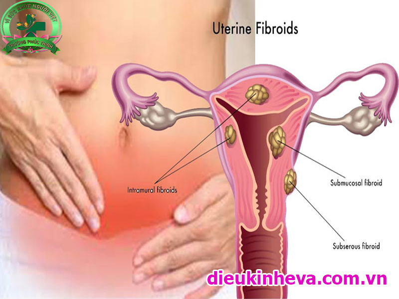 Bệnh U xơ tử cung nguyên nhân triệu chứng chuẩn đoán điều trị phòng tránh