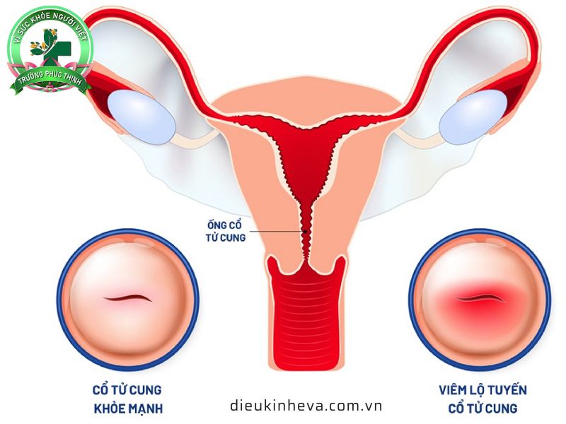 Viêm lộ tuyến nếu không điều trị triệt để sẽ có thể gây vô sinh