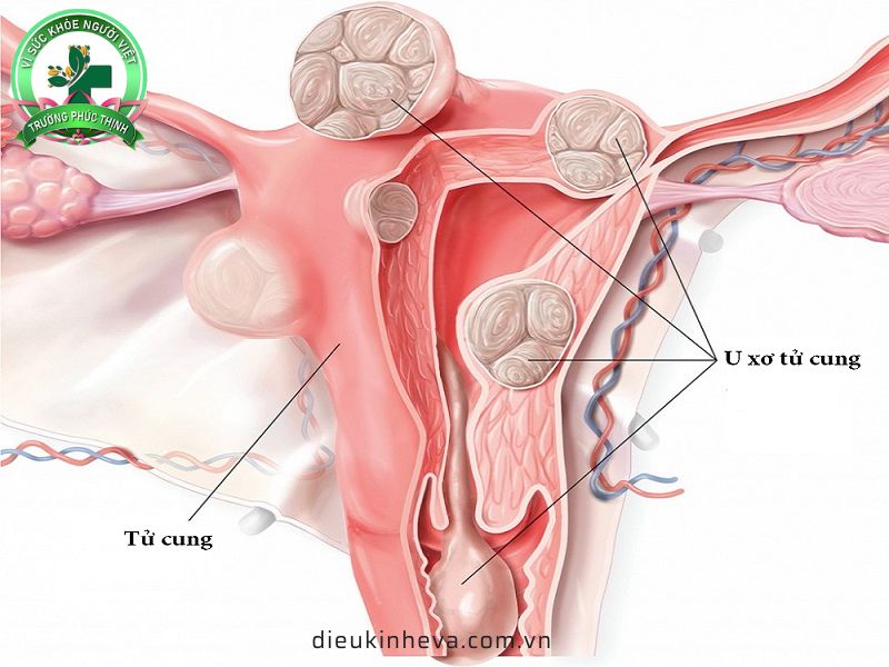 U xơ tử cung là 1 trong 5 bệnh phụ khoa dễ gây vô sinh ở nữ giới