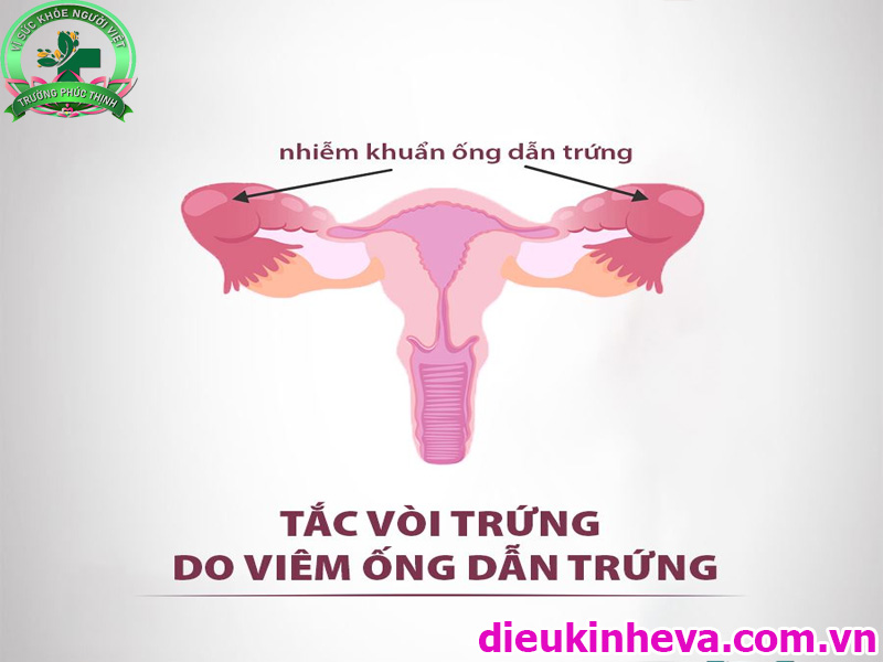 Bệnh tắc vòi chứng do nhiều nguyên nhân