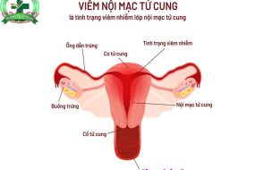 Hiểu rõ về viêm nội mạc tử cung: Bệnh lý phụ khoa phổ biến