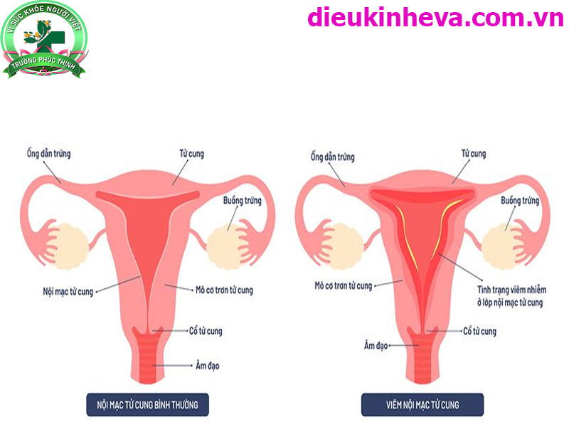 Viêm nội mạc tử cung cần thăm khám và điều trị kịp thời