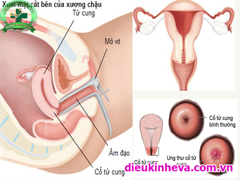 Viêm cổ tử cung là trạng thái sưng viêm ở cổ tử cung