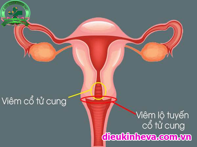 Sự khác biệt của viêm cổ tử cung và viêm lộ tuyến cổ tử cung