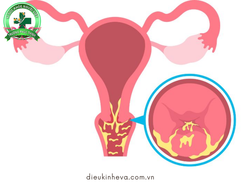 Viêm lộ tuyến cổ tử cung là bệnh lý phụ khoa khá phổ biến