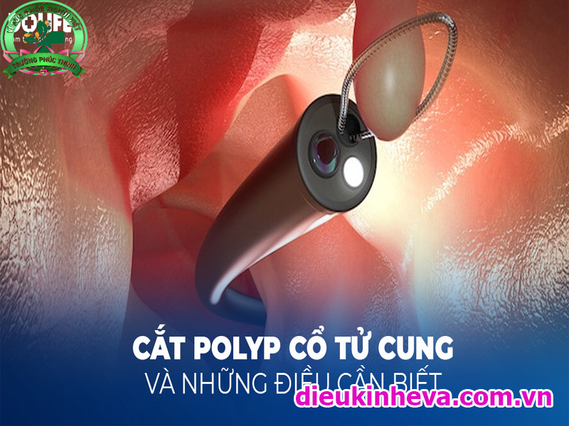Polyp tử cung là một khối u nhỏ mọc bất thường cần loại bỏ